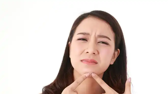 Cara Mengatasi Jerawat dengan Minum Air Putih, Simak!