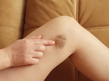 10 Cara Menghilangkan Bekas Luka di Kaki yang Lama & Menghitam